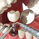Tytanowe implanty zębów Toruń - stomatologia estetyczna