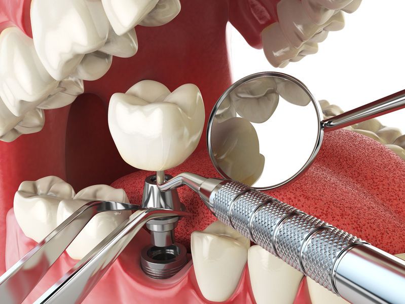 Tytanowe implanty zębów Toruń - stomatologia estetyczna