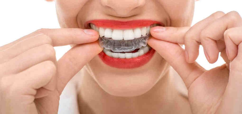 wybielanie zębów toruń - Dentysta toruń stomatologia estetyczna