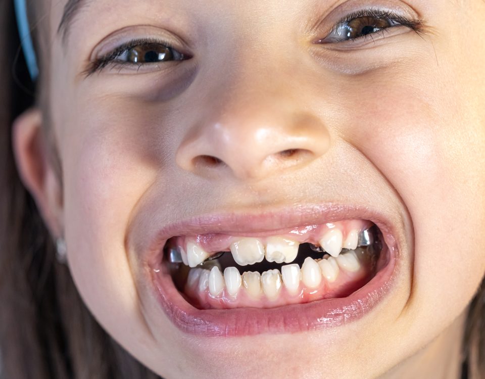 Czy zęby mleczne są równie ważne jak stałe?