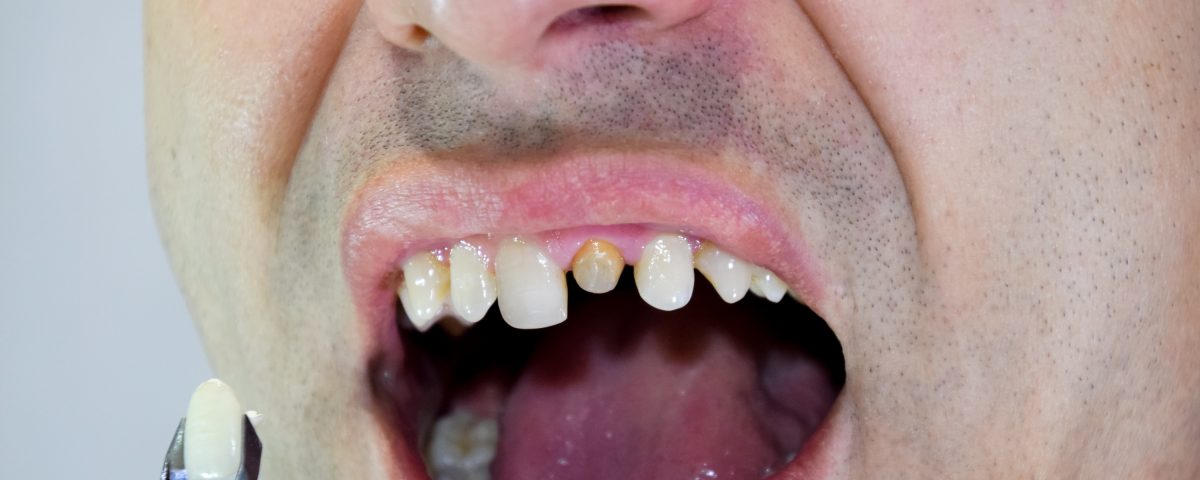 Erozja Zębów: Przyczyny, Objawy i Sposoby Zapobiegania