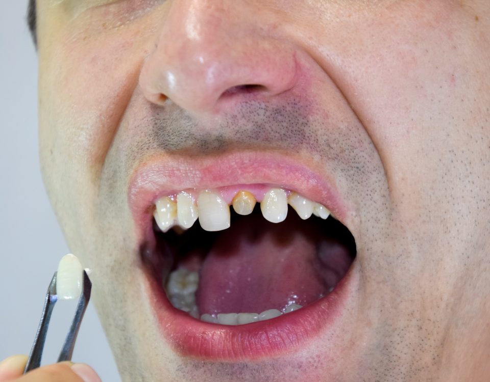 Erozja Zębów: Przyczyny, Objawy i Sposoby Zapobiegania
